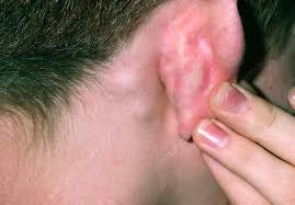 lymph node, best lymphatic drainage massage Singapore