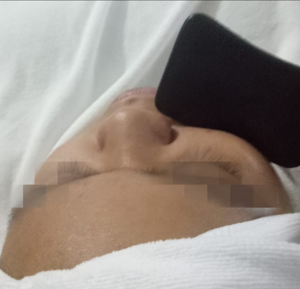 muslimah facial Singapore acne jeragat