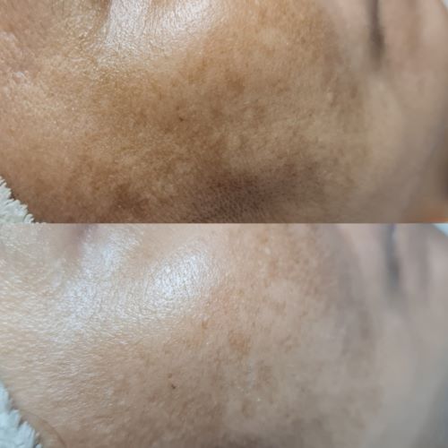 collagen laser remove milia seed angomia wart facial