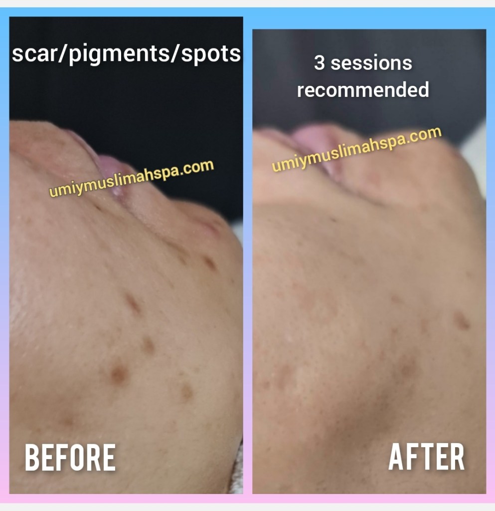 back acne treatment singapore